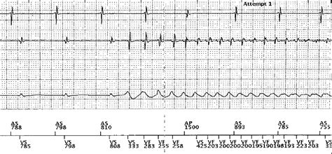 icd 10 left ventricular hypertrophy.